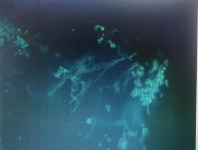 ​什么是花斑癣 花斑癣和花斑糠疹一样吗 怎么治疗花斑癣