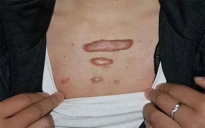 ​什么是疤痕增生的消除方法疤痕增生如何消除？祛除疤痕增生最好的方法）